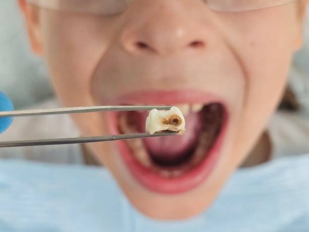Best Emergency Dentist for Lost Fillings or Crowns in South Bend, IN